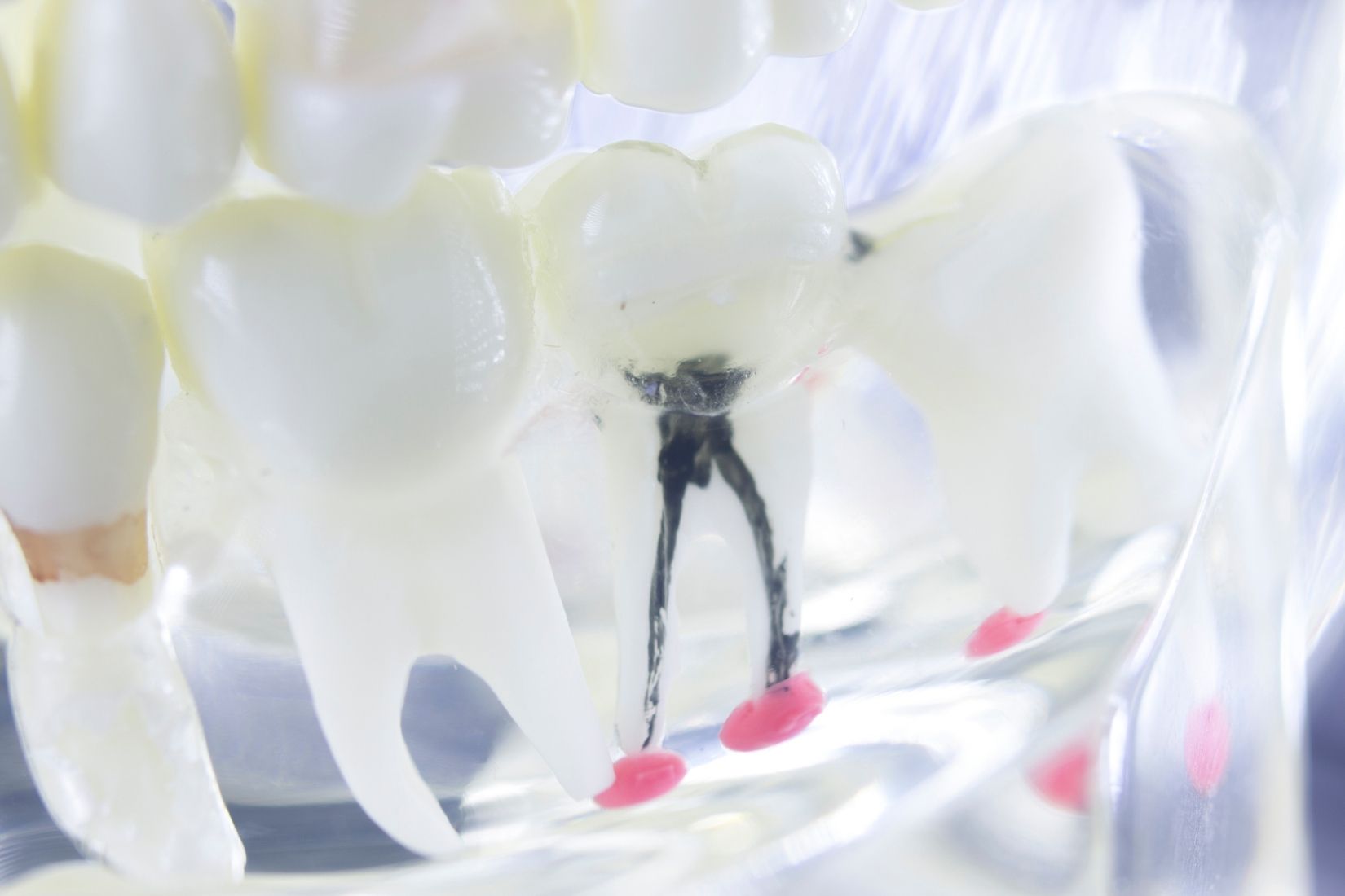 Apikal rezeksiyon sonrası kök ucu, dikiş ve kemik iyileşme sürecini gösteren bilgilendirici dental görsel.
