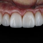 Diş beyazlatma sonrası zamanla oluşabilecek renk değişimini ve doğal diş tonlarının karşılaştırmasını gösteren dental görsel.