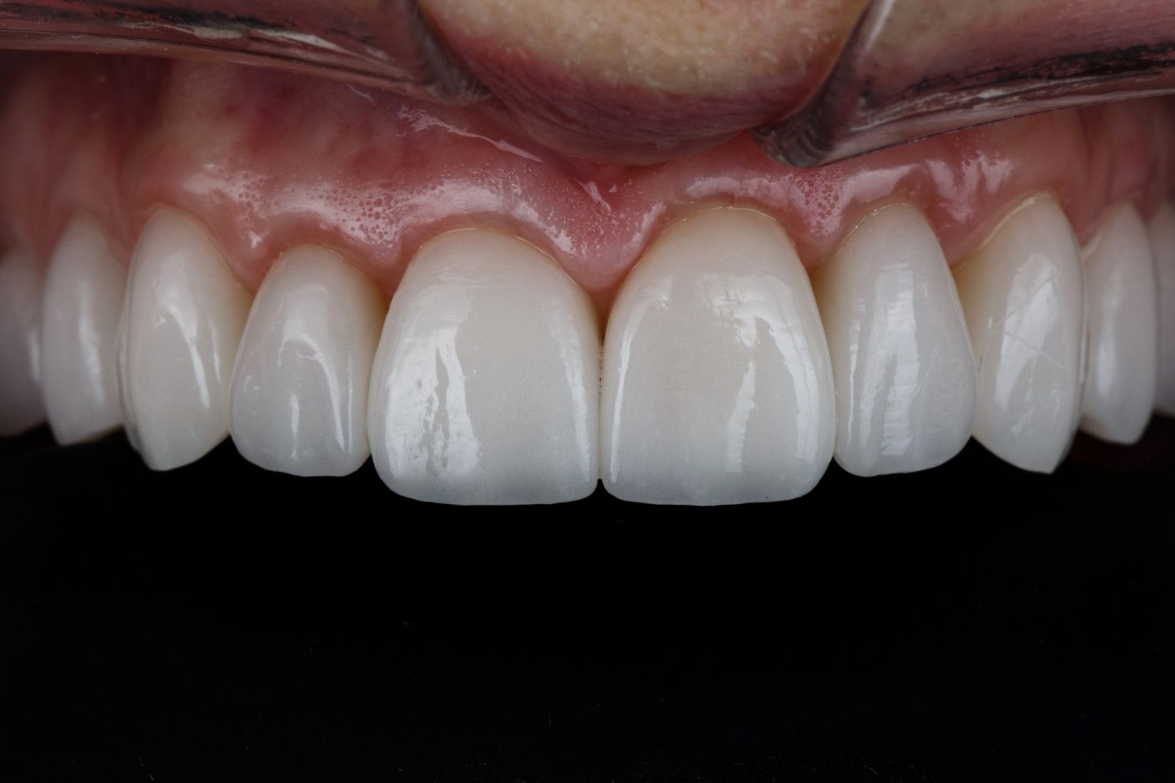 Diş beyazlatma sonrası zamanla oluşabilecek renk değişimini ve doğal diş tonlarının karşılaştırmasını gösteren dental görsel.