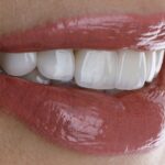 E-Max kaplamada çatlak, kırık ve çiğneme kuvvetlerinin restorasyon üzerindeki etkilerini gösteren dental görsel.