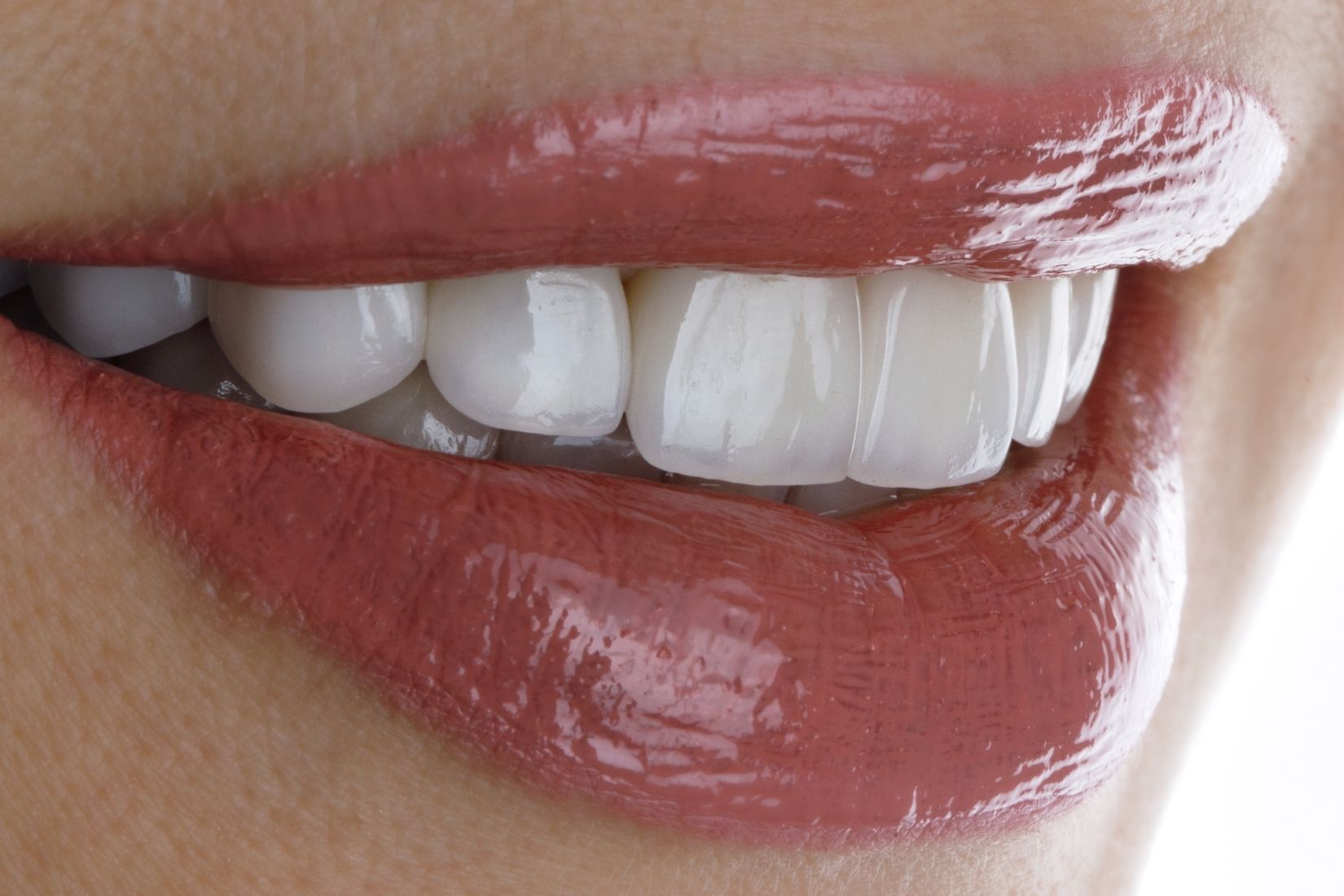 E-Max kaplamada çatlak, kırık ve çiğneme kuvvetlerinin restorasyon üzerindeki etkilerini gösteren dental görsel.