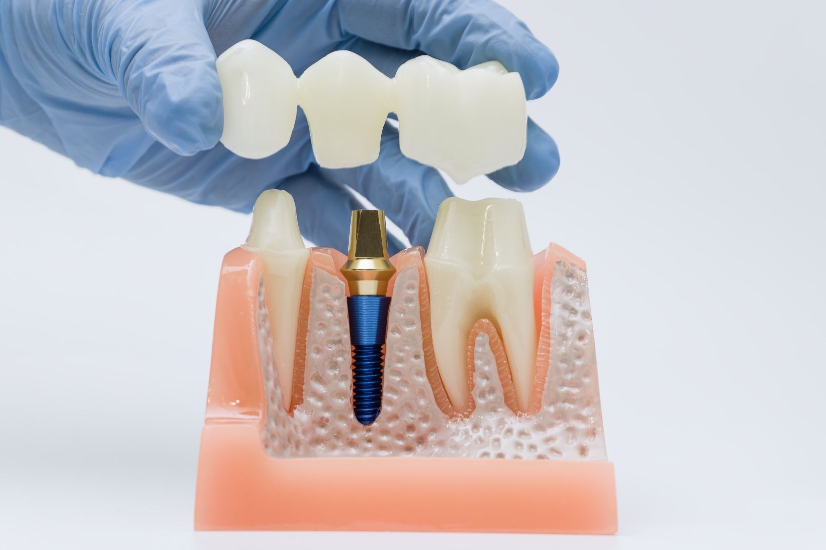 Sabit, hareketli ve tam ark implant üstü protez seçeneklerini gösteren bilgilendirici dental görsel.
