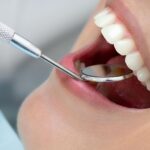 Kompozit bonding restorasyonunda zamanla oluşabilecek renk ve yüzey değişikliklerini gösteren bilgilendirici dental görsel.