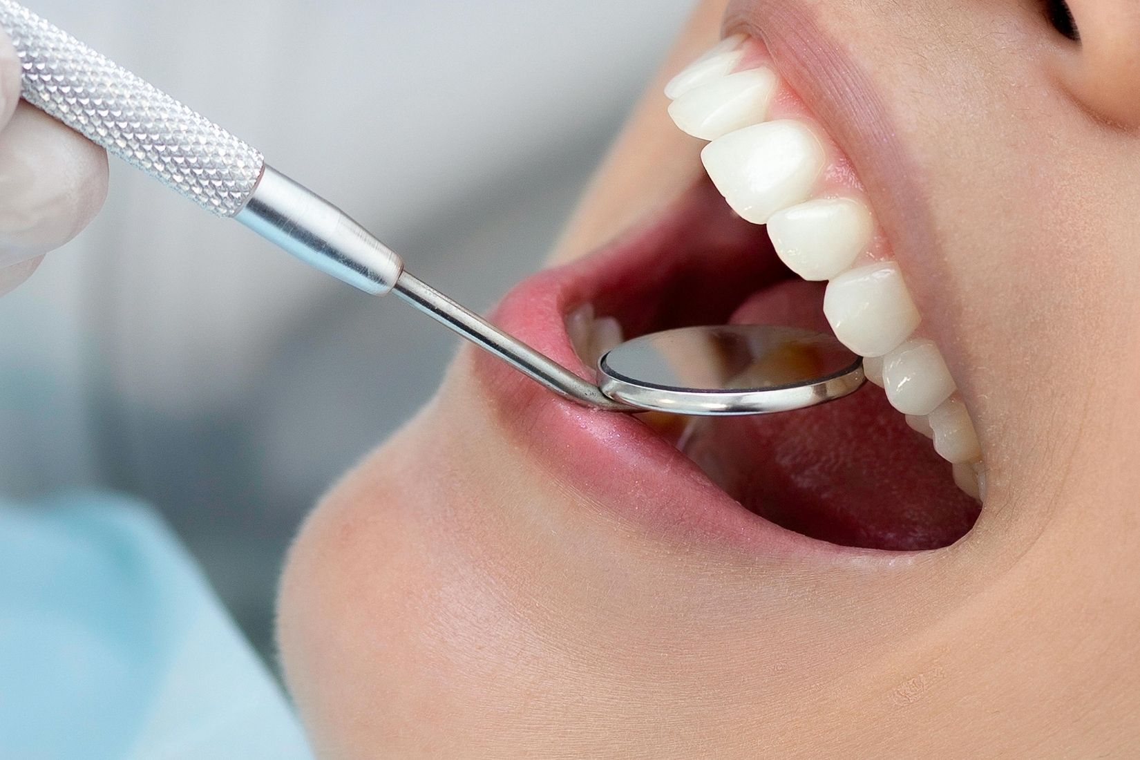 Kompozit bonding restorasyonunda zamanla oluşabilecek renk ve yüzey değişikliklerini gösteren bilgilendirici dental görsel.