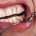 Çiğneme sırasında basınca ağrıyan dişte kök, çatlak, dolgu ve çevre dokuların değerlendirilmesini gösteren dental görsel.