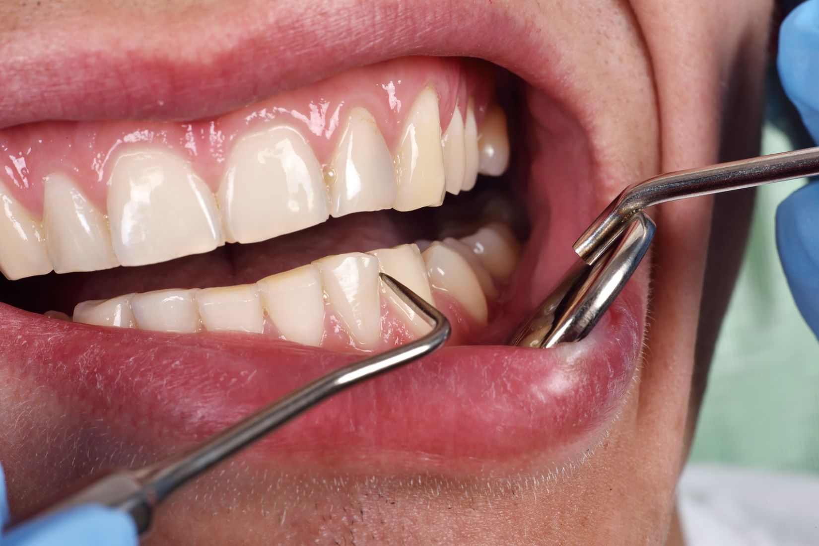 Çiğneme sırasında basınca ağrıyan dişte kök, çatlak, dolgu ve çevre dokuların değerlendirilmesini gösteren dental görsel.