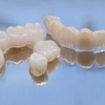 Hazırlanmış doğal diş üzerine yerleştirilen geçici kron ile kalıcı diş kaplamasının aşamalarını gösteren dental görsel.