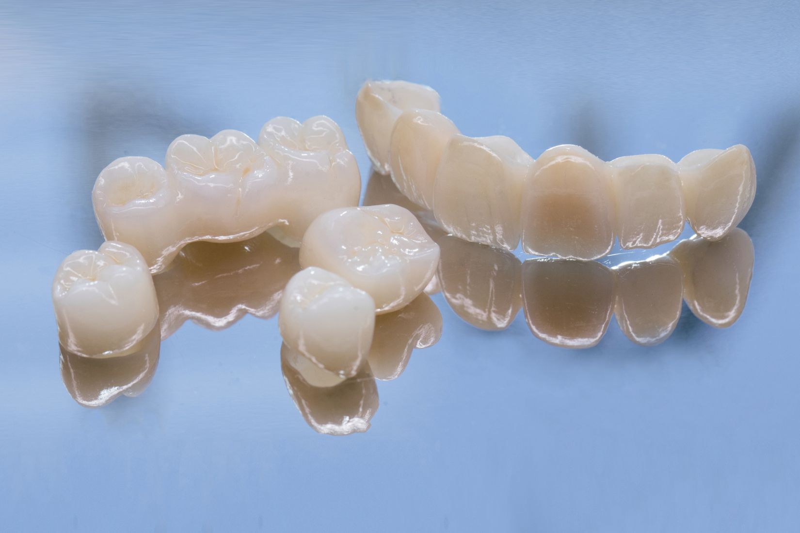 Hazırlanmış doğal diş üzerine yerleştirilen geçici kron ile kalıcı diş kaplamasının aşamalarını gösteren dental görsel.