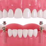 Dental implantın çene kemiğine yerleştirilmesi, osseointegrasyon ve implant üstü protez aşamalarını gösteren görsel.