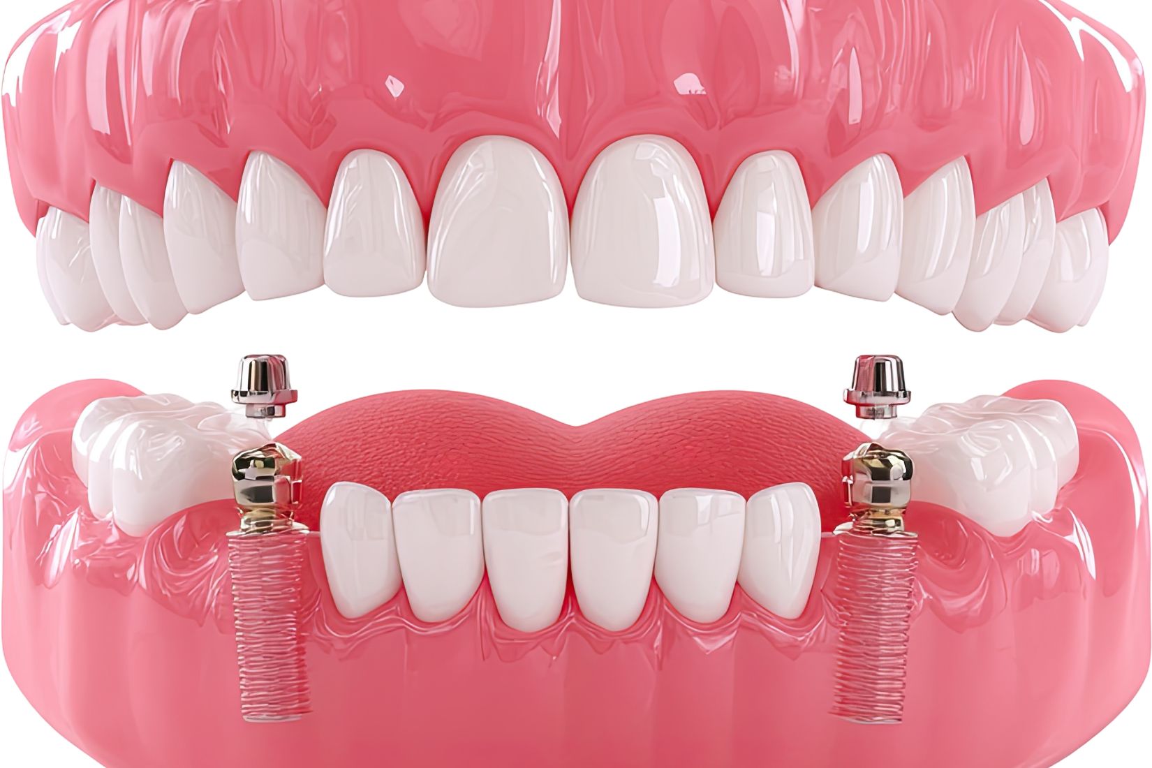 Dental implantın çene kemiğine yerleştirilmesi, osseointegrasyon ve implant üstü protez aşamalarını gösteren görsel.