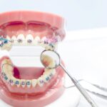 Şeffaf plak ve sabit diş teli sistemlerinin görünümünü ve ortodontik kullanım farklılıklarını karşılaştıran bilgilendirici dental görsel.