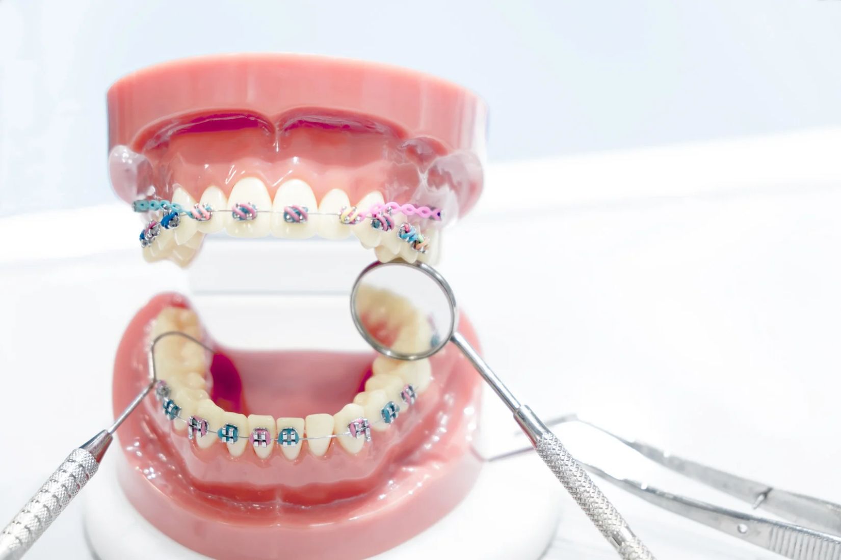 Şeffaf plak ve sabit diş teli sistemlerinin görünümünü ve ortodontik kullanım farklılıklarını karşılaştıran bilgilendirici dental görsel.