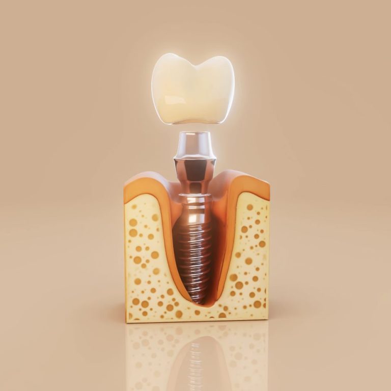 Dental implantın çene kemiği içine yerleştirilmesini gösteren şematik diş hekimliği görseli