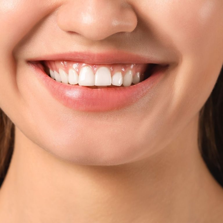 Dişler arasında oluşan diş eti şişliği ve interdental papil değişikliklerini gösteren bilgilendirici dental görsel.
