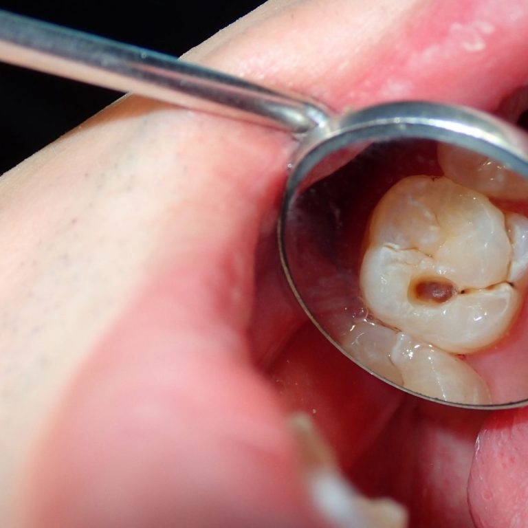 Diş çürüğünün başlangıç aşamalarını, plak oluşumunu ve mine tabakasındaki değişimleri gösteren dental görsel.