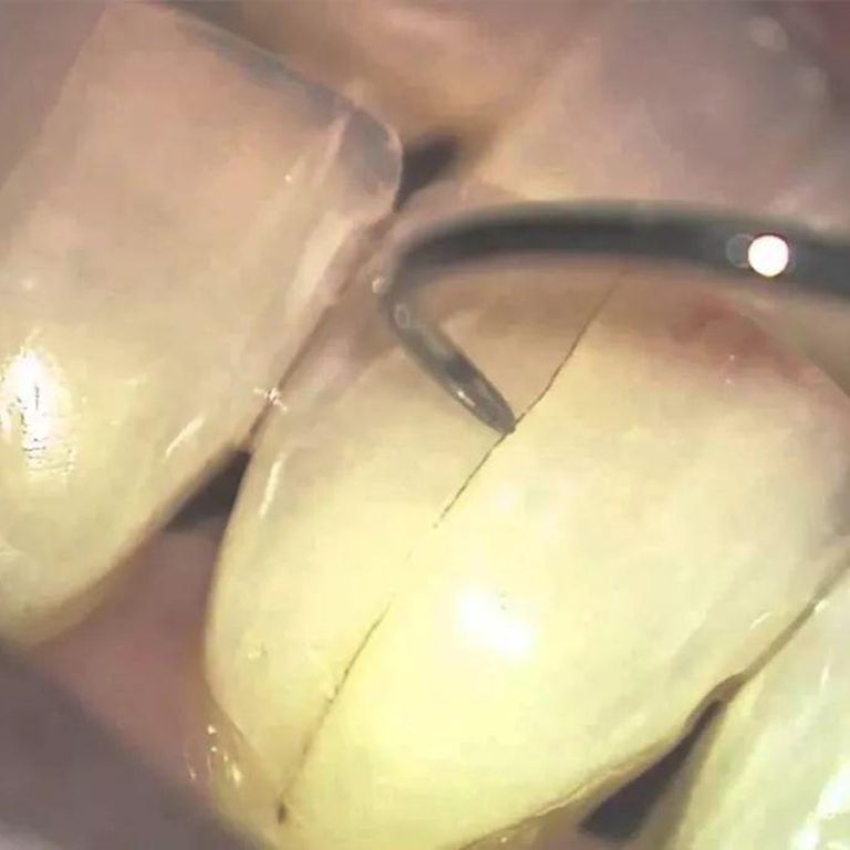 Diş çatlağını, mine yüzeyindeki ince çizgileri ve diş hekimi muayenesini gösteren dental bilgilendirme görseli.