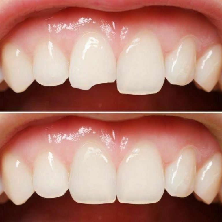 Dişlerde şekil bozukluğu, bonding, porselen lamine ve ortodontik tedavi ile düzeltme sürecini gösteren görsel.