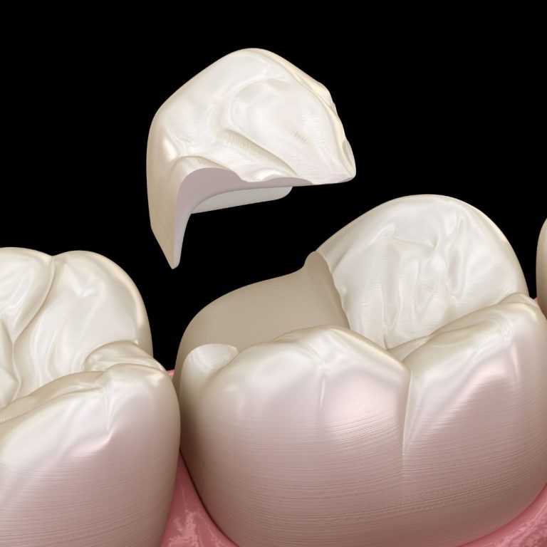 Dolgulu dişte restorasyon ile doğal diş arasındaki kenar sızıntısını ve marjinal uyumu gösteren dental görsel.