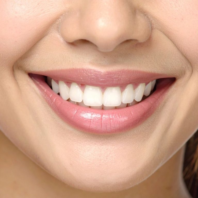 Gummy smile görünümü, diş eti seviyesi ve gülüş estetiği değerlendirmesini gösteren bilgilendirici dental görsel.