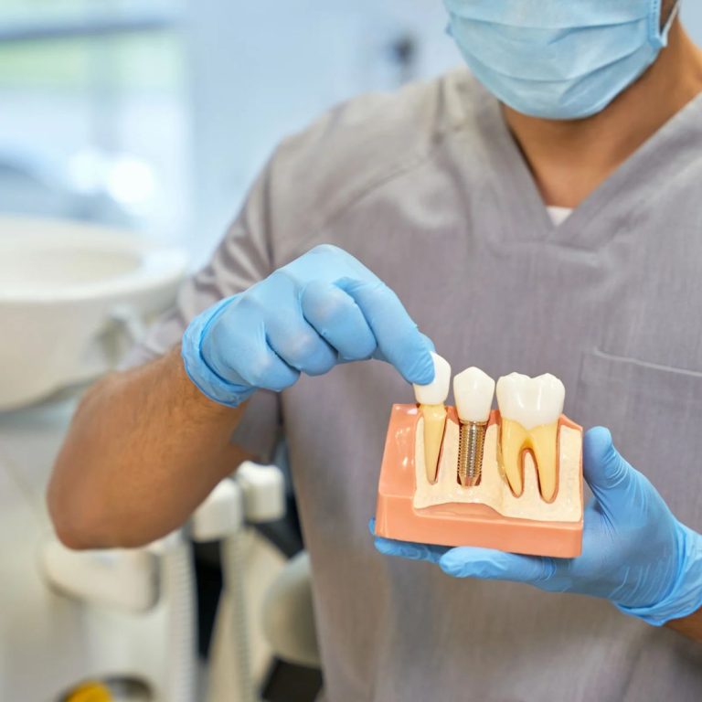 İmplant çevresinde diş eti çekilmesi, kemik seviyesi ve implant üstü protez ilişkisini gösteren bilgilendirici dental görsel.