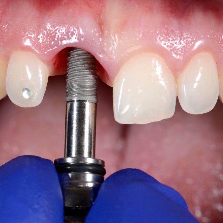 Dijital implant planlama, CBCT görüntüleme ve rehberli cerrahi teknolojilerini gösteren modern diş hekimliği görseli.