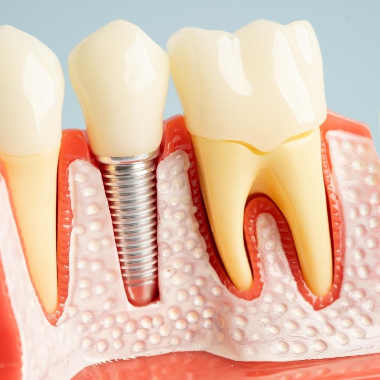 Üst çenede kemik yetersizliği olan bölgede sinüs lifting ve kemik grefti uygulamasını gösteren diş hekimliği görseli