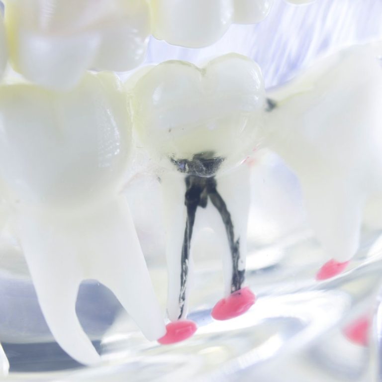 Apikal rezeksiyon sonrası kök ucu, dikiş ve kemik iyileşme sürecini gösteren bilgilendirici dental görsel.