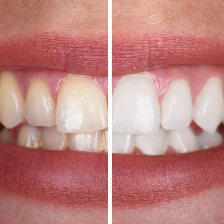 Konya’da diş beyazlatma planlamasında renk analizi ve diş muayenesini gösteren bilgilendirici dental görsel.