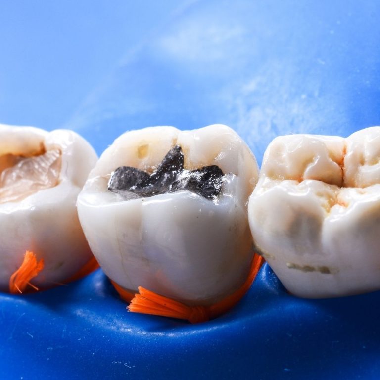 Konya’da diş dolgusu planlaması, çürük muayenesi ve kompozit restorasyon aşamalarını gösteren bilgilendirici dental görsel.