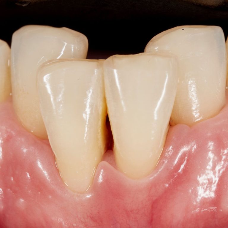 Diş eti çekilmesi, açığa çıkan kök yüzeyi ve periodontal değerlendirmeyi gösteren bilgilendirici dental görsel.