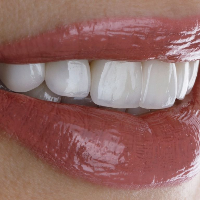 E-Max kaplamada çatlak, kırık ve çiğneme kuvvetlerinin restorasyon üzerindeki etkilerini gösteren dental görsel.