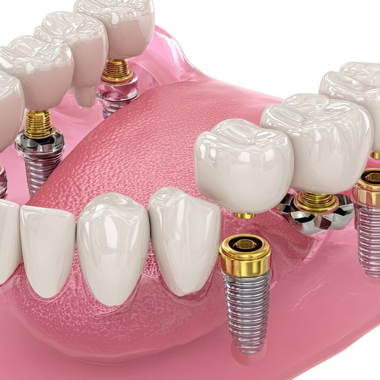 Konya full mouth implant tedavisi, All-on-4 sistemi ve implant üstü sabit protez planlamasını gösteren dental görsel.