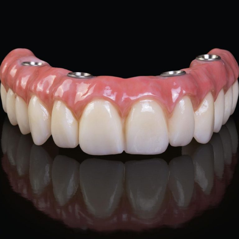 Konya full mouth implant tedavisi ile tüm ağız sabit implant protez uygulamasını gösteren diş hekimliği görseli.