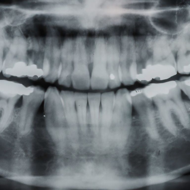 Konya gömülü diş ameliyatında yirmi yaş dişinin konumu ve cerrahi çekim planlamasını gösteren bilgilendirici dental görsel.