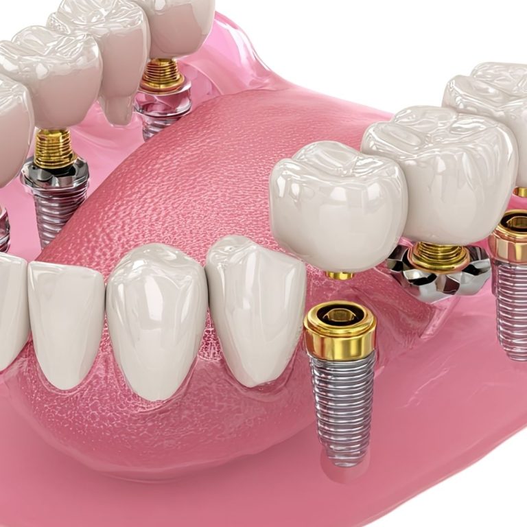 Konya’da implant üstü protez planlaması, abutment seçimi ve sabit protez aşamalarını gösteren bilgilendirici dental görsel.