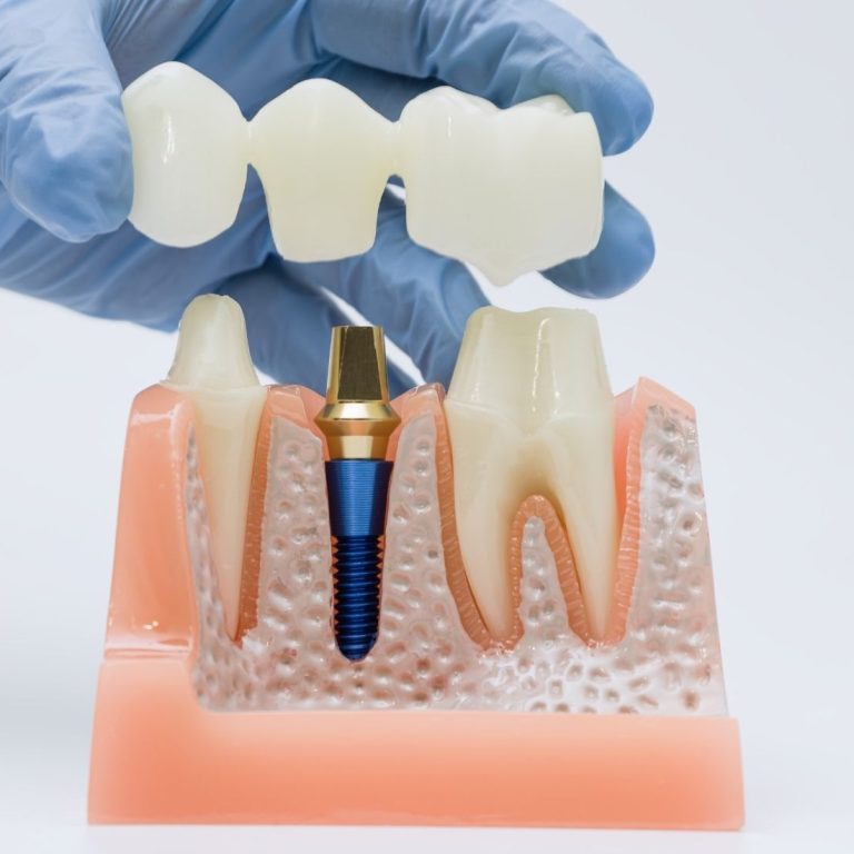 Sabit, hareketli ve tam ark implant üstü protez seçeneklerini gösteren bilgilendirici dental görsel.