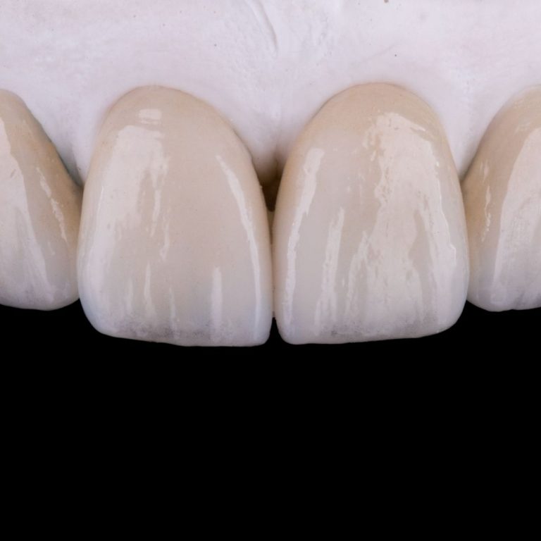 Konya lamina diş uygulamaları, porselen yaprak diş ve gülüş tasarımı planlamasını gösteren dental görsel.