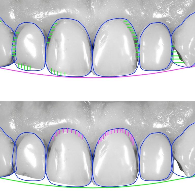 Konya ön diş estetiği uygulamalarında lamina, bonding ve gülüş tasarımı planlamasını gösteren dental görsel.