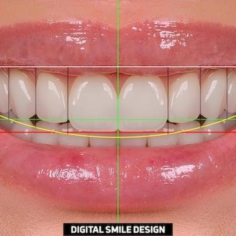 Konya ön diş estetiği planlama sürecinde gülüş tasarımı ve diş form analizini gösteren diş hekimliği görseli.