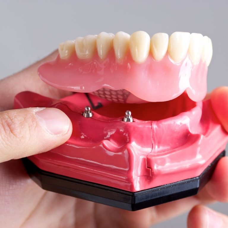 Konya Toronto protezi, tam çene implantları ve sabit implant üstü protez planlamasını gösteren bilgilendirici dental görsel.