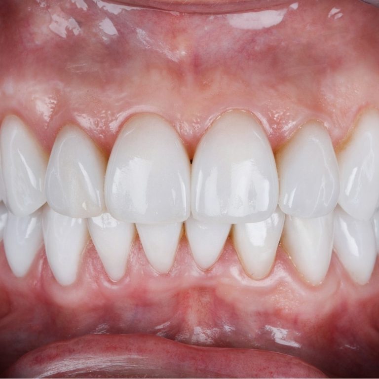 Ön diş estetiğinde beyazlatma, bonding, porselen lamine ve gülüş planlamasını gösteren bilgilendirici dental görsel.