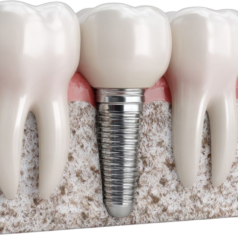 Dental implant çevresinde yeni kemik oluşumunu ve osseointegrasyon sürecini gösteren bilgilendirici tıbbi görsel.
